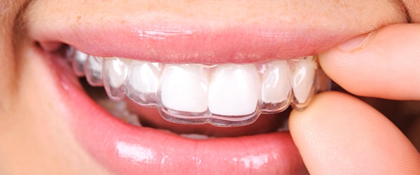 Invisalign Invisalign