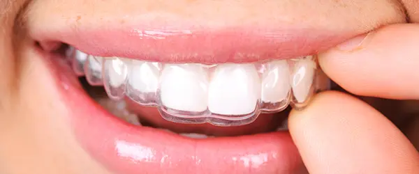 Invisalign