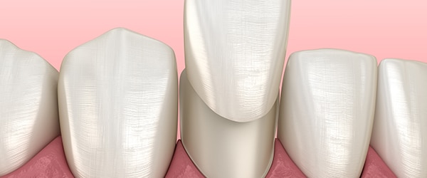Veneers Veneers