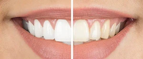 Whitening